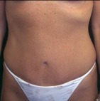 Tummy Tuck