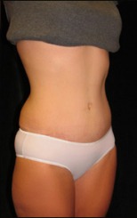 Tummy Tuck