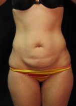 Tummy Tuck