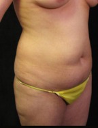 Tummy Tuck