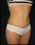 Tummy Tuck