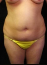 Tummy Tuck