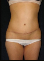 Tummy Tuck