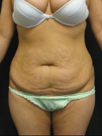 Tummy Tuck