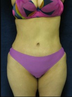 Tummy Tuck