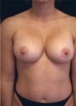 Breast Augmentation