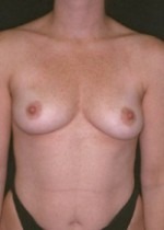 Breast Augmentation