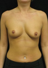 Breast Augmentation