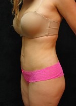 Tummy Tuck