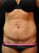 Tummy Tuck