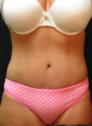 Tummy Tuck Case 3420 After Photo Tummy Tuck