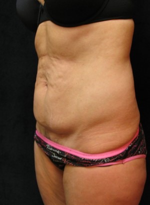Tummy Tuck Case 3420 Before Photo Tummy Tuck