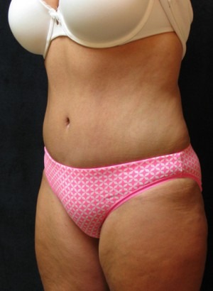 Tummy Tuck Case 3420 After Photo Tummy Tuck