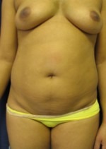 Tummy Tuck