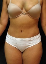 Tummy Tuck