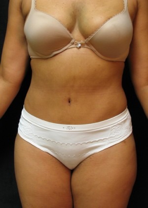 Tummy Tuck Case 3426 After Photo Tummy Tuck
