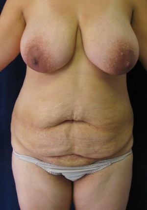 Tummy Tuck