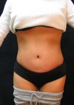 Tummy Tuck