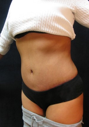 Tummy Tuck