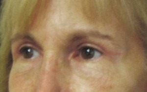 Eyelid Surgery Case 3483 After Photo Eyelid Surgery