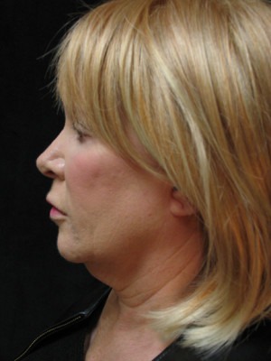 Face, Brow & Neck Lifts Case 3517 Before Photo Face, Brow & Neck Lifts