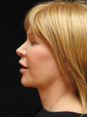 Face, Brow & Neck Lifts Case 3517 After Photo Face, Brow & Neck Lifts