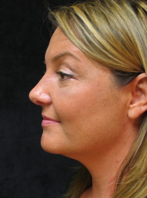 Nose Reshaping