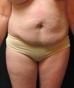 Tummy Tuck