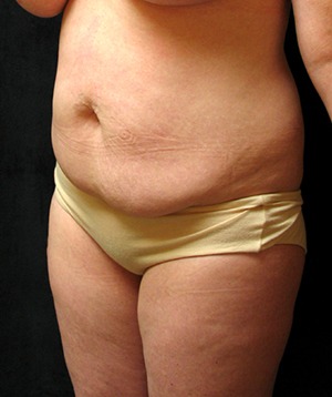 Tummy Tuck Case 3545 Before Photo Tummy Tuck