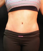 Tummy Tuck