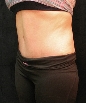 Tummy Tuck Case 3545 After Photo Tummy Tuck