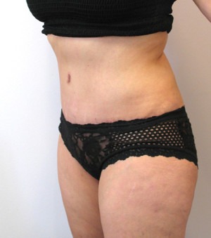 Tummy Tuck