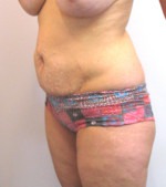 Tummy Tuck