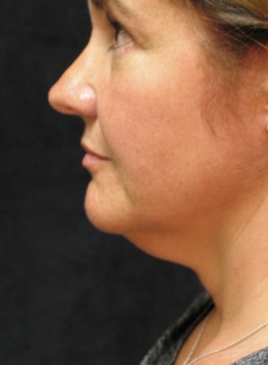 Face, Brow & Neck Lifts Case 3589 Before Photo Face, Brow & Neck Lifts