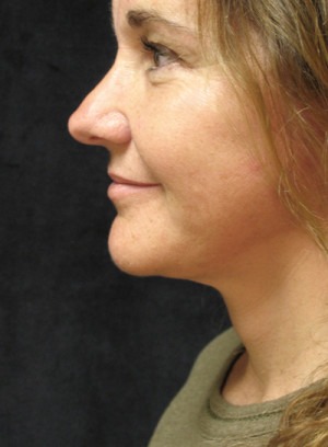 Face, Brow & Neck Lifts Case 3589 After Photo Face, Brow & Neck Lifts
