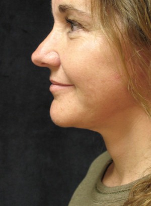 Face, Brow & Neck Lifts