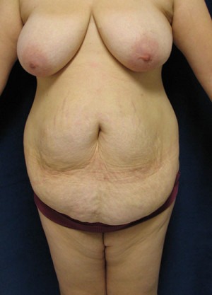 Tummy Tuck