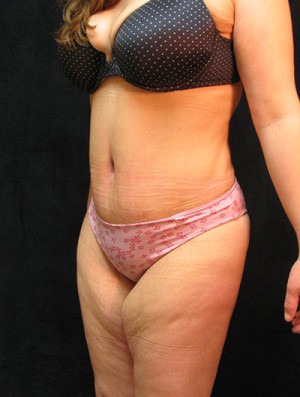 Tummy Tuck