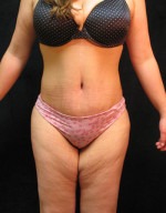 Tummy Tuck