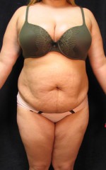 Tummy Tuck