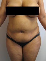 Tummy Tuck