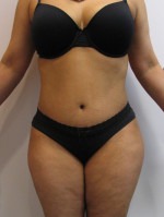 Tummy Tuck