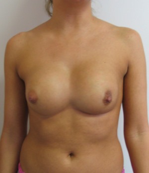 Breast Implant Repair Case 3774 Before Photo Breast Implant Repair