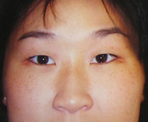 Eyelid Surgery Case 3878 Before Photo Eyelid Surgery