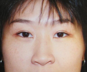 Eyelid Surgery Case 3878 After Photo Eyelid Surgery
