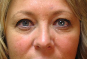 Eyelid Surgery Case 3879 Before Photo Eyelid Surgery