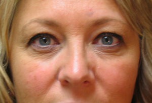 Eyelid Surgery