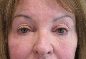 Eyelid Surgery Case 3880 After Photo Eyelid Surgery