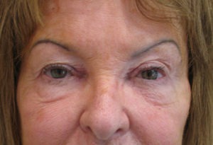 Eyelid Surgery Case 3880 Before Photo Eyelid Surgery