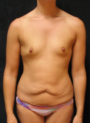 Mommy Makeover Case 3933 Before Photo Mommy Makeover